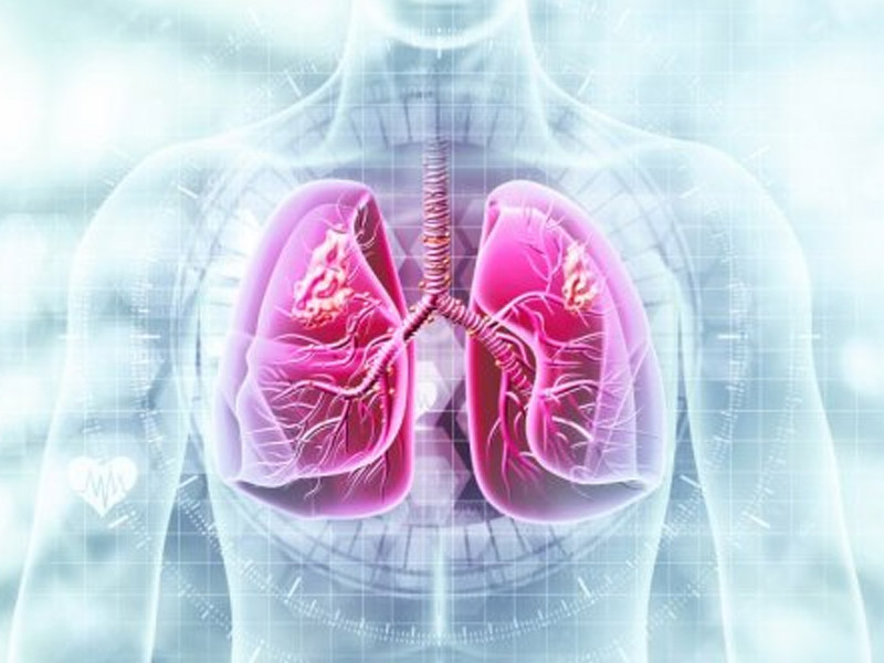 Karcinom pluća | Poliklinika EsoLab Lukavac